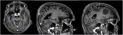 Neurotoxicity-sparing radiotherapy for brain metastases in breast cancer: a narrative review